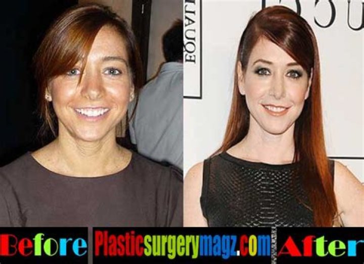 Alyson Hannigan Facelift Plastic Surgery Before and After