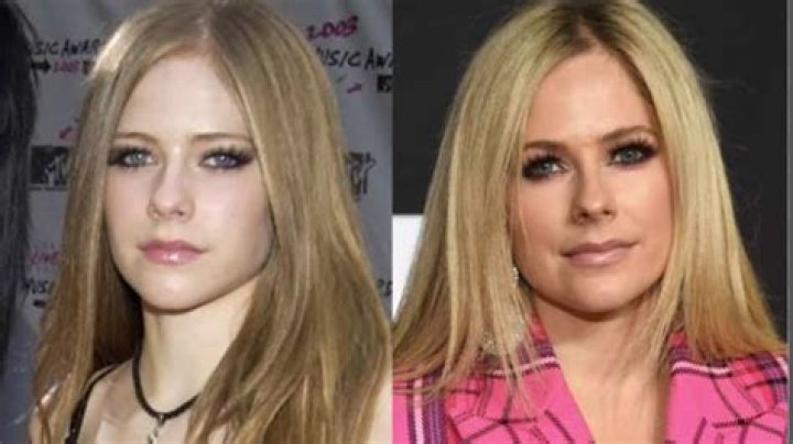 Avril Lavigne Nose Job Plastic Surgery Before and After