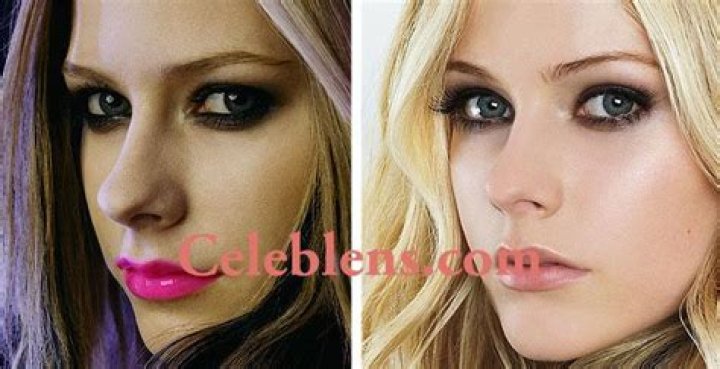 Avril Lavigne Plastic Surgery Before and After