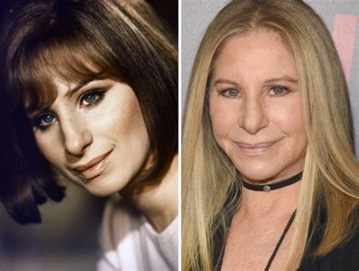 Barbra Streisand Plastic Surgery: Debunking the Facelift Rumors and Wrinkle-Free Speculations