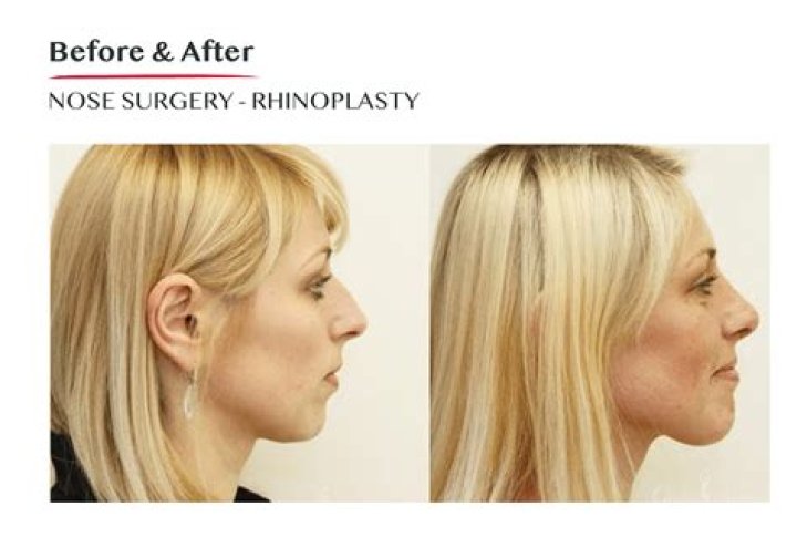 Celine Dion Nose Job Plastic Surgery Before and After