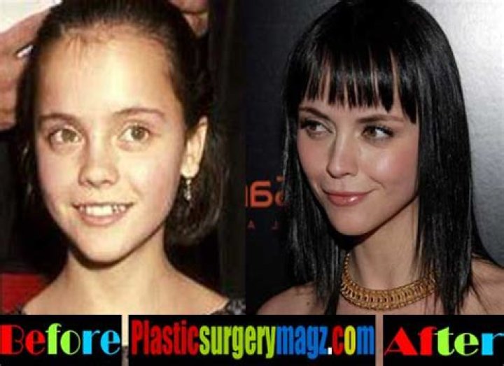 Christina Ricci Plastic Surgery Before and After