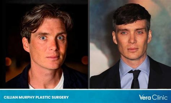 Cillian Murphy Plastic Surgery: Murphy's Static Look Credited To?