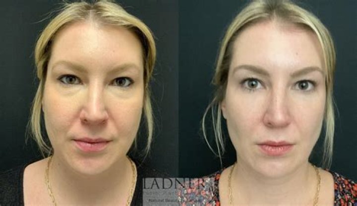 Frances Bean Cobain Nose Job Plastic Surgery Before and After