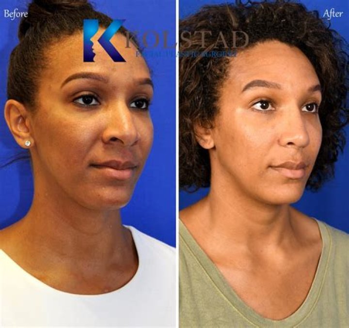 Jay-Z Nose Job Plastic Surgery Before and After