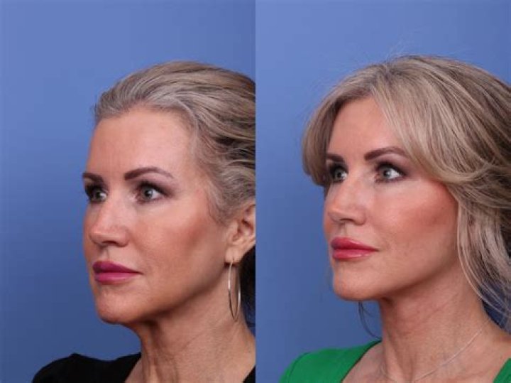 Linda Thompson Facelift Plastic Surgery Before and After