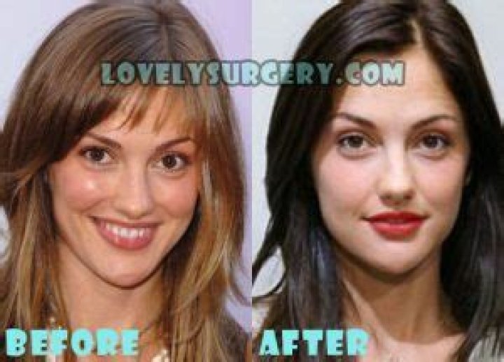 Minka Kelly Plastic Surgery Before and After
