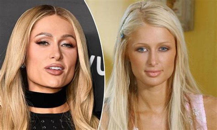Paris Hilton Nose Job Plastic Surgery Before and After